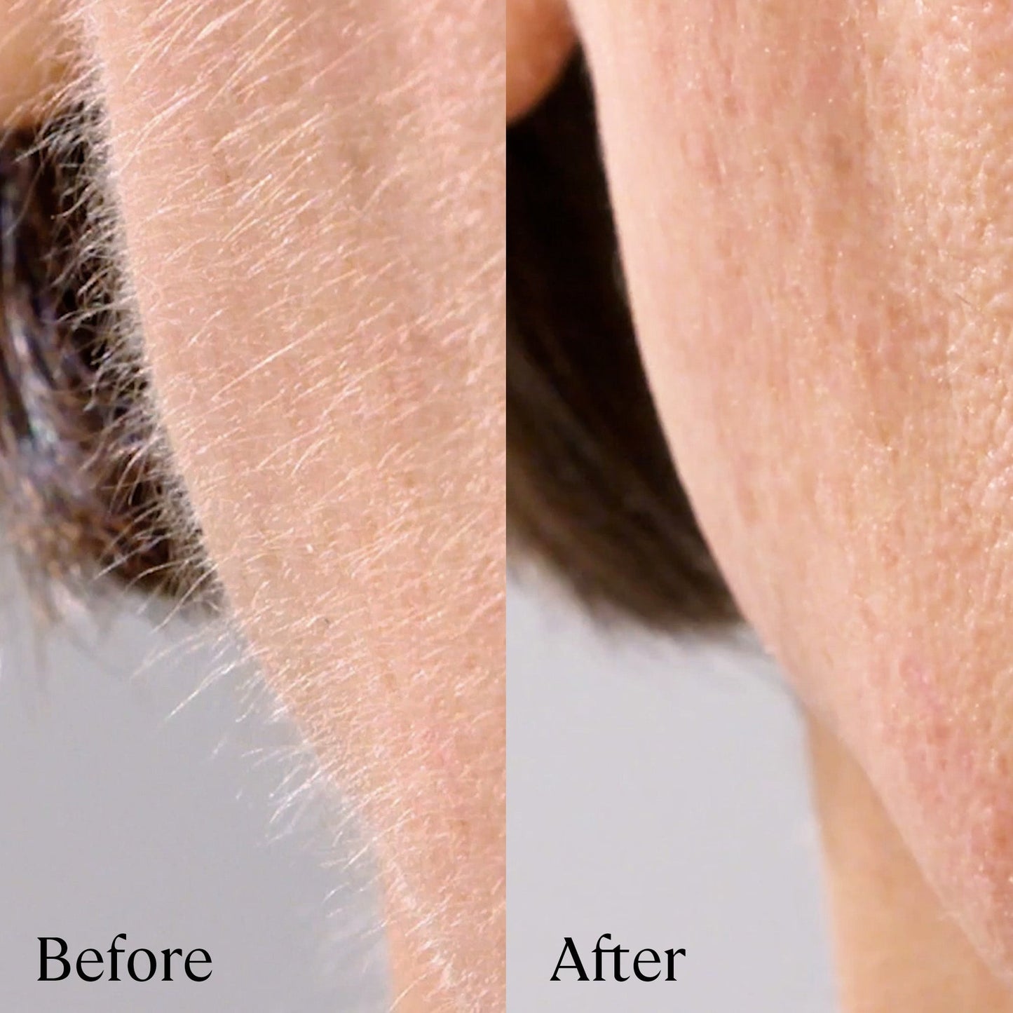 Close-up of facial skin before and after using the Michael Todd Beauty Sonicsmooth Pro+ System; the "before" shows more hair and texture, while the "after" appears smoother with less visible hair.