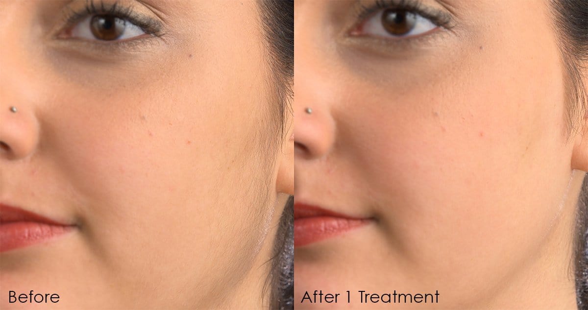 Before and after comparison of facial skin showing noticeable improvement in texture and clarity following one treatment with the Sonicsmooth Refill Tips tool from Michael Todd Beauty.