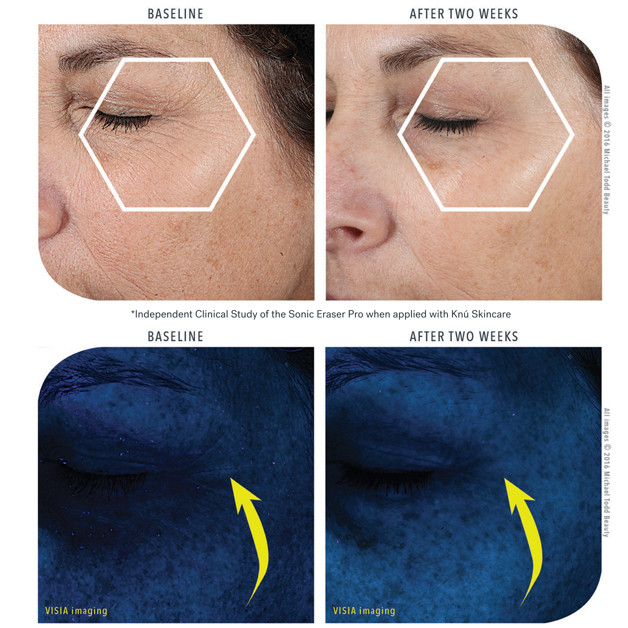 Lavender Lust. Comparison images showing skin improvements in eye area before and after two weeks of using Michael Todd Beauty's 4 in 1 Dermaplaning & Post Treatment System, with close-ups and marked analysis areas.