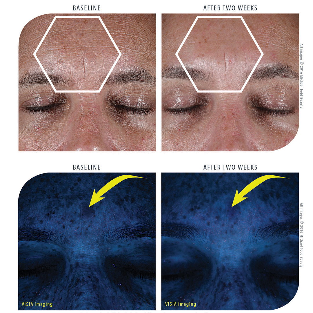 The woman's face is displayed before and after a treatment using Michael Todd Beauty's Glow All Day Bundle.