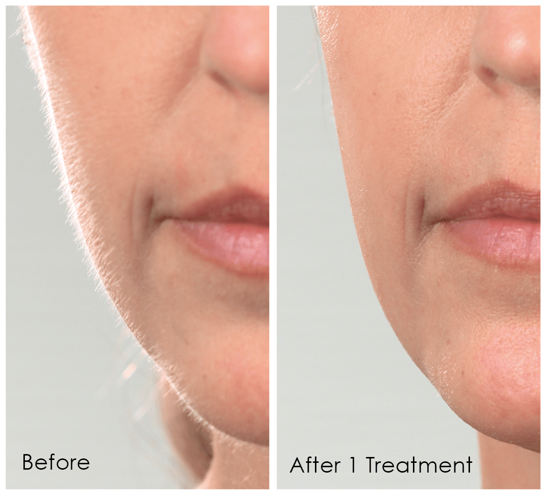 Side-by-side close-up images of a woman's lower face showing skin before and after a single Sonic Dermaplane treatment with Michael Todd Beauty's Sonicsmooth Pro+ Clear Refill Tips, highlighting a visible reduction in fine lines.